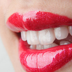 Focus On sull'estetica dentale: cosa sono le faccette estetiche dentali