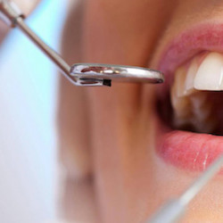 Laser Odontoiatrico, la soluzione ideale anche per la parodontite